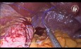 Laparoscopic Sleeve Gastrectomy with Omentopexy and Gastric Posterior Wall Fixation for Untwisting Remnant Stomach