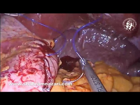 Laparoscopic Sleeve Gastrectomy with Omentopexy and Gastric Posterior Wall Fixation for Untwisting Remnant Stomach