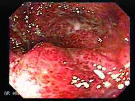 Colitis Ulcerosa - Pancolitis (3 of 7)