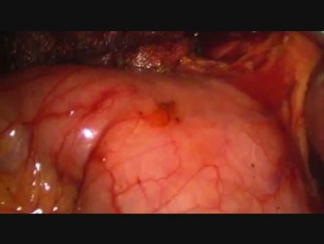 Laparoscopic CBD Exploration and T tube Placement
