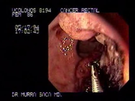 Colonoscopy - Adenocarcinoma Of The Cecum (3 of 4)