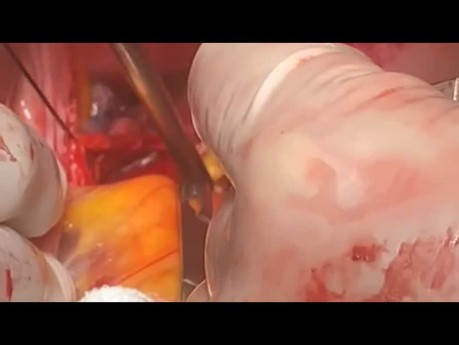 Patient with Simultaneous Coarctation and Dissection Undergone Bypass and Repair Dissection 