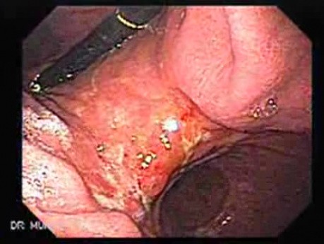 Adenocarcinoma of the Lesser Curvature with Signet Ring Cells (3 of 3) 2
