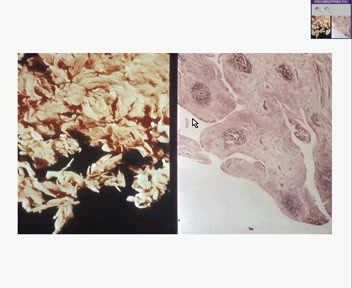 Rheumatoid Arthritis