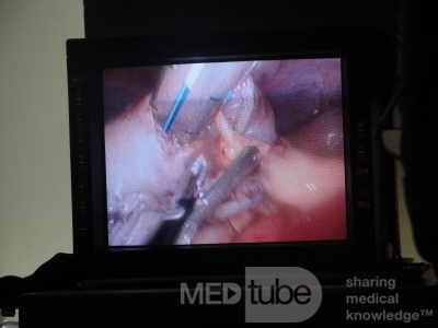 Gastric Ulcerated Adenocarcinoma of the Pre-pyloric Antrum (8 of 28)