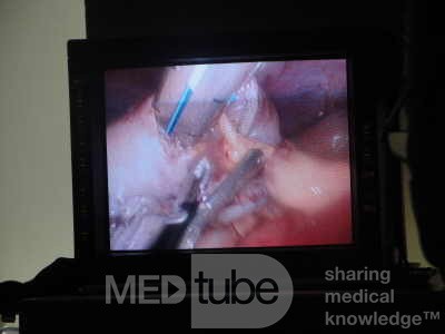Gastric Ulcerated Adenocarcinoma of the Pre-pyloric Antrum (8 of 28)