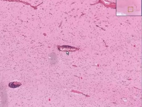 Viral encephalitis