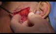 Preauricolar Transparotid Approaches in Bilateral Extracondilar Mandibular Fractures