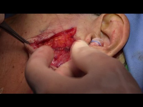 Preauricolar Transparotid Approaches in Bilateral Extracondilar Mandibular Fractures