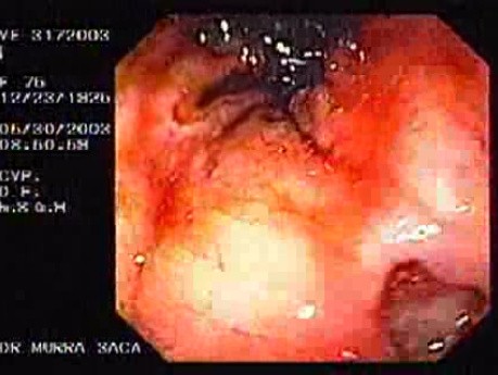 Upper Gastrointestinal Bleeding (4 of 15)