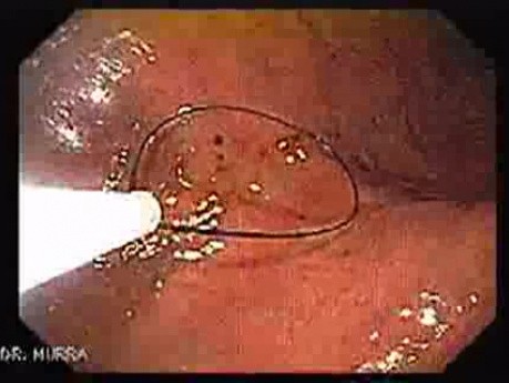Percutaneous Endoscopic Gastrostomy - PEG (2 of 6)