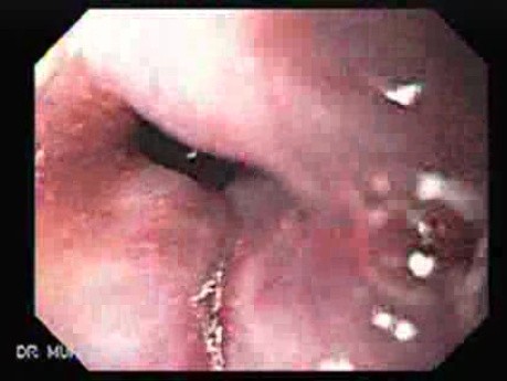 Hemorrhage After Ligation - Some Ligated Varices