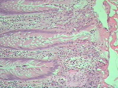 Case on Multiple Adenomas (large polyps) of the Rectum (37 of 37)