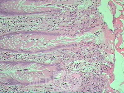 Case on Multiple Adenomas (large polyps) of the Rectum (37 of 37)
