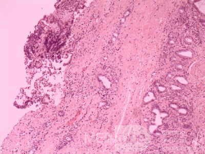 Cholangiocarcinoma that infiltrated a Periampullary Duodenal Diverticula and the head of the pancreas (18 of 20)