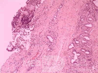 Cholangiocarcinoma that infiltrated a Periampullary Duodenal Diverticula and the head of the pancreas (18 of 20)