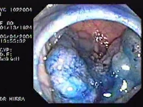 Sessile Villous Adenoma (3 of 3)