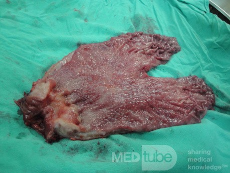 Gastric Ulcerated Adenocarcinoma of the Pre-pyloric Antrum (27 of 28)