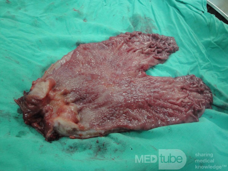 Gastric Ulcerated Adenocarcinoma of the Pre-pyloric Antrum (27 of 28)
