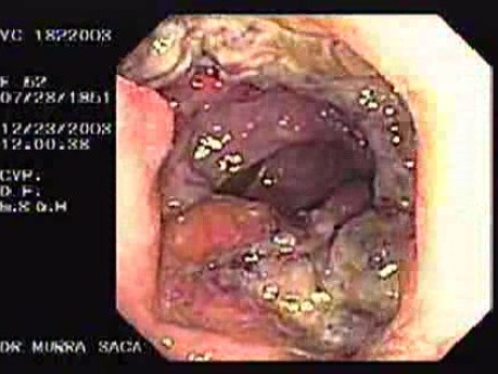 Colonoscopy - Adenocarcinoma Of The Cecum (4 of 4)
