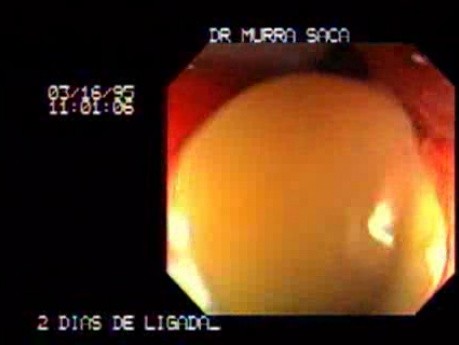 Status Post Rubber Band Ligation (1 of 3)