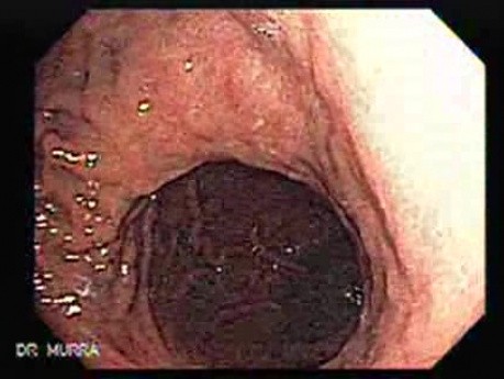 Hourglass Stomach - Equatorial Constricion
