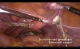 Adnextomy for borderline ovarian tumor