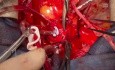 Redo Operation for Patient with Coronary Artery Ostia 2