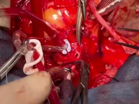 Redo Operation for Patient with Coronary Artery Ostia 2