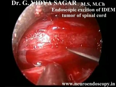 Endoscopic Excition of IDEM tumor of Spinal Cord