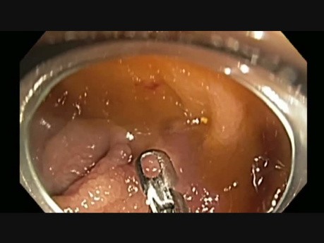 Colonoscopy - LST Granular Tumor - Biopsy