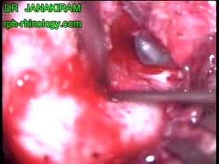 Subperiosteal Abscess