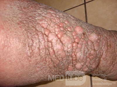 Elephantiasis nostras verrucosa on the legs with morbid
 obesity (5 of 5)
