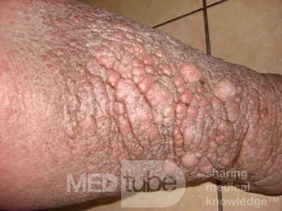 Elephantiasis nostras verrucosa on the legs with morbid
 obesity (5 of 5)