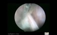 TVL Using Tenaculum For Adhesion Removal 
