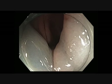 Colonoscopy - II B Lesion adjacent to EMR Scar