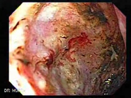 Adenocarcinoma of the Antrum with Duodenal Infiltration (3 of 3)