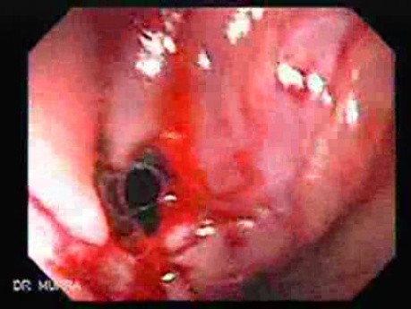 Consecutive colonoscopy with dilation was carried out (14 of 15)