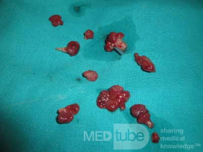 Huge Mass of the Descending Colon (25 of 25)
