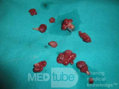 Huge Mass of the Descending Colon (25 of 25)