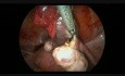 Laproscopic Salpingectomy Due to EP
