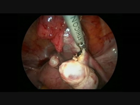 Laproscopic Salpingectomy Due to EP