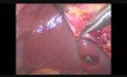 Lap Cholecystectomy