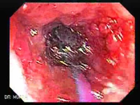 Colonoscopy with Dilation (4 of 8)