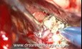 Skull Base Tumor - Dorsum Sella Meningioma - Microsurgical Removal