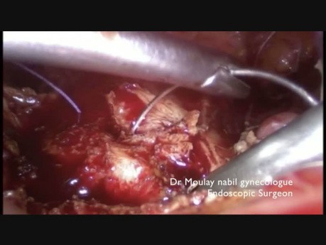 Laparoscopy for Cesarean Scar Defect