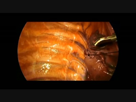 Thoracoscopic Resection of the Apex of the Lung in Spontaneous Pneumothorax