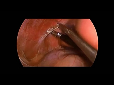 Laparoscopic Adrenalectomy in Child