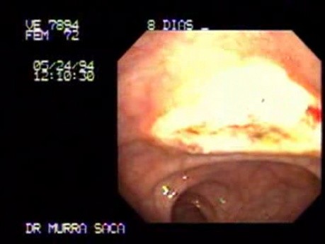 Video Colonoscopic view of a polypectomy of a big 6 cm. x 4 cm. sessile lesion (4 of 4)
