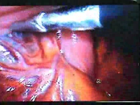 Jejunal Gastrointestinal Stromal tumor (GIST) (24 of 86)